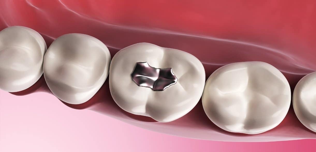 How Long Does Tooth Filling Last?