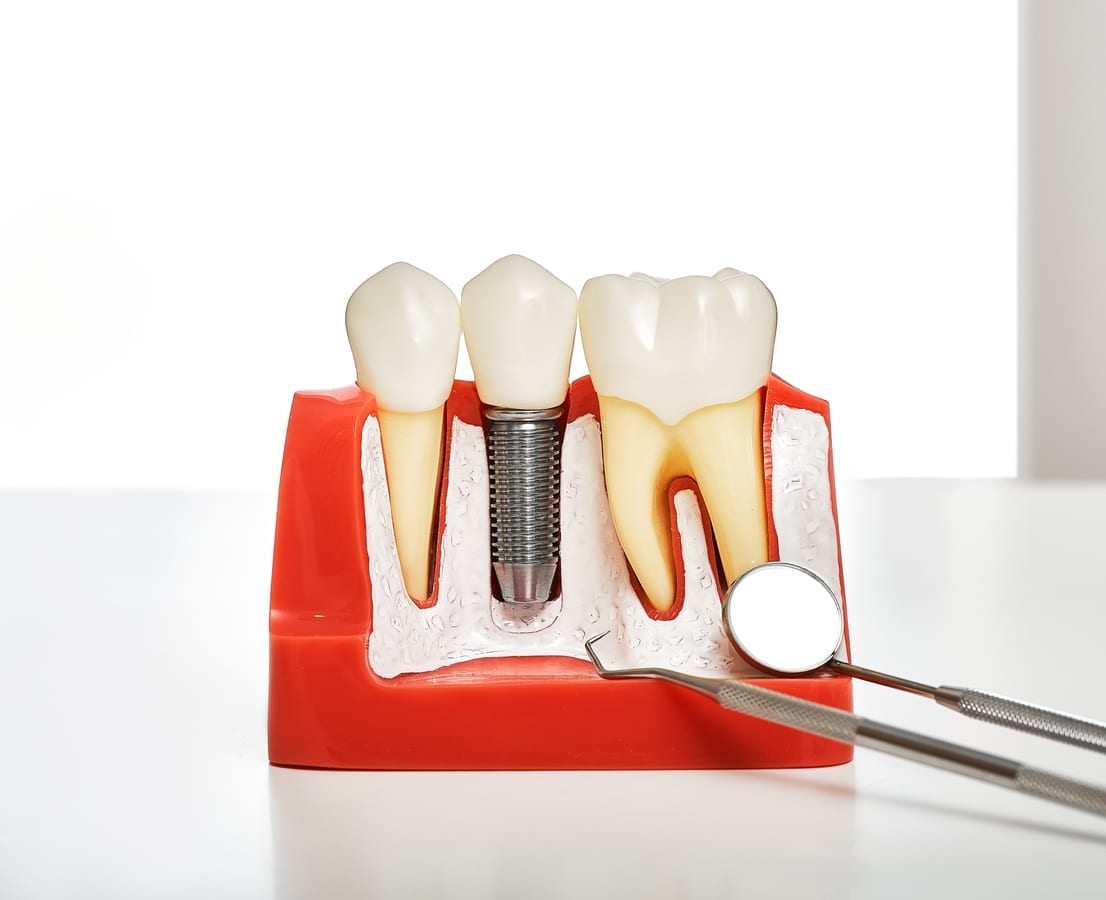 Dental Implant Myths Debunked