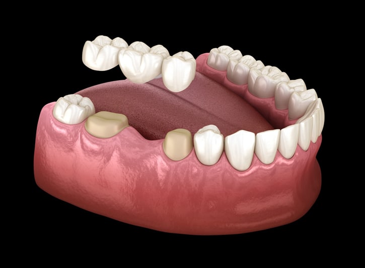 dental bridges in san antonio