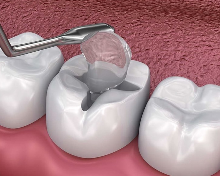 dental bridges in san antonio