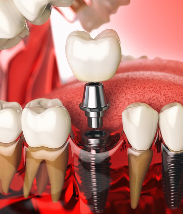 dental bridges in san antonio