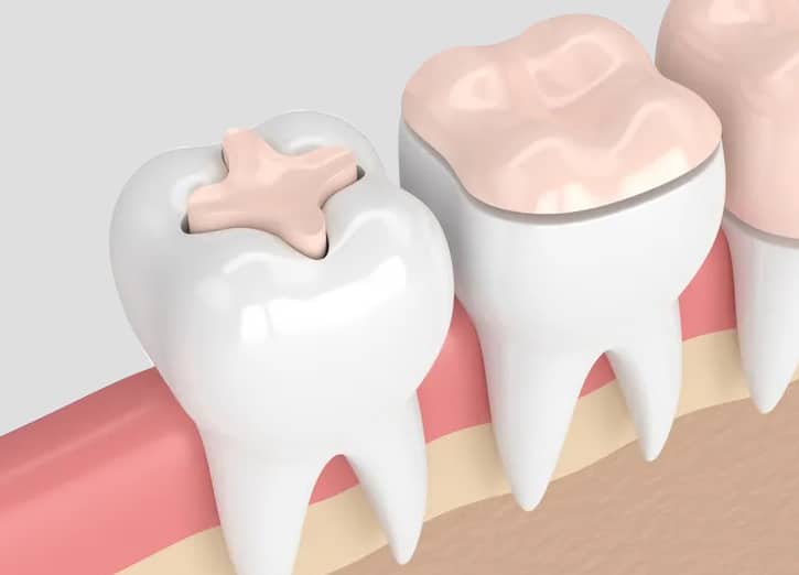 dental bridges in san antonio