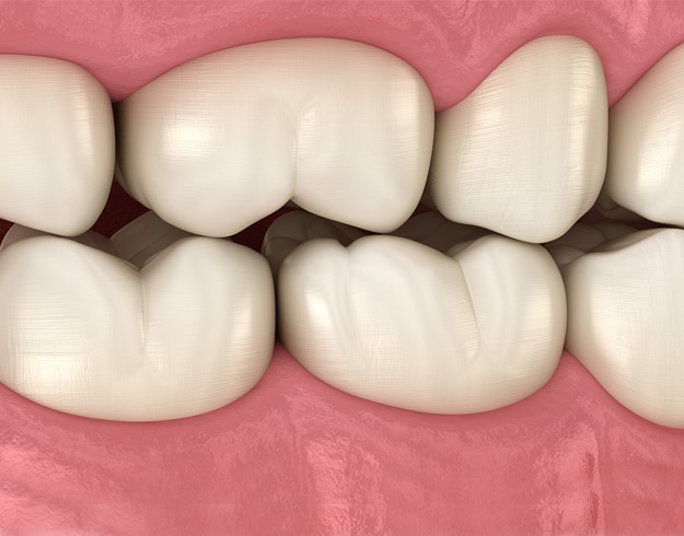 dental bridges in san antonio