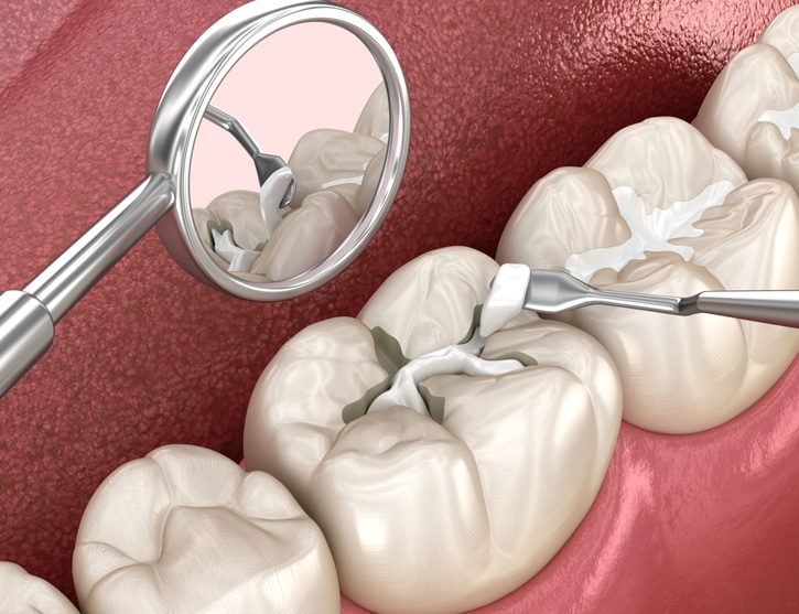 dental bridges in san antonio