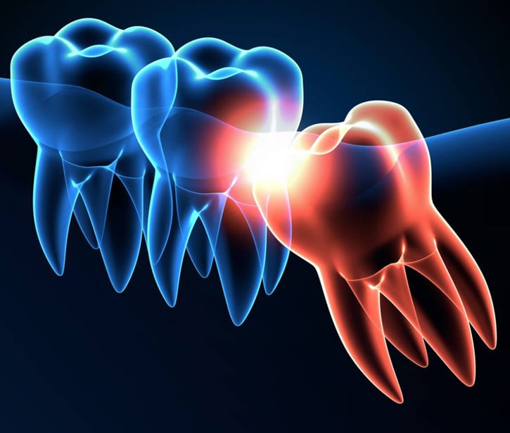 dental bridges in san antonio