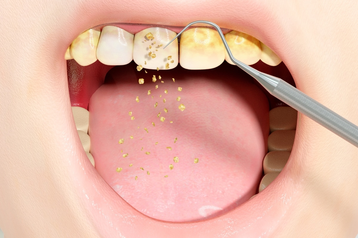 how to remove permanent yellow stains from teeth