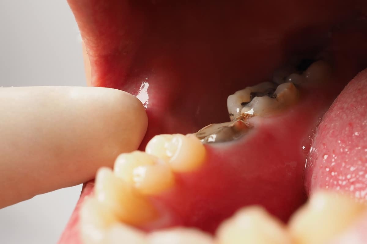 what should you do if your wisdom tooth has a cavity