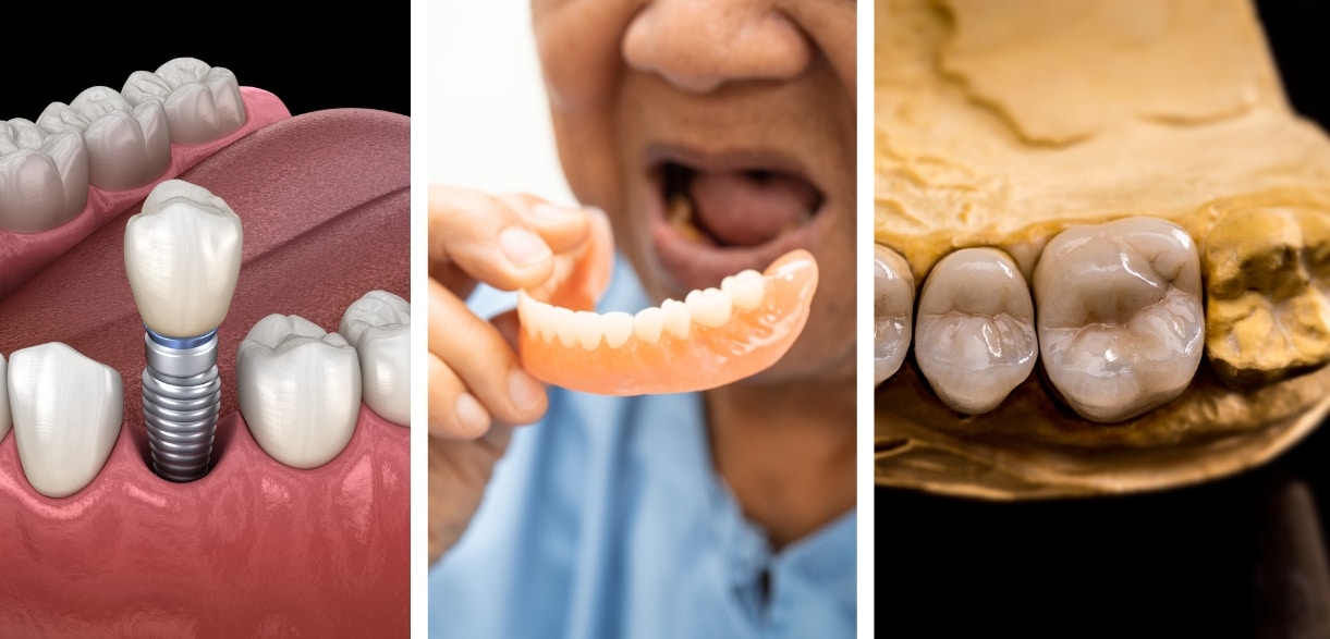 dental implants vs. dentures vs. bridges: which is the best choice for you