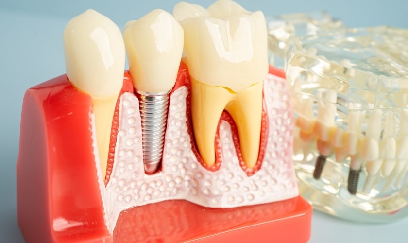 dental implants in Frisco
