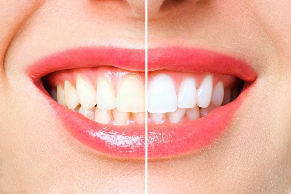 teeth-whitening-in-Frisco