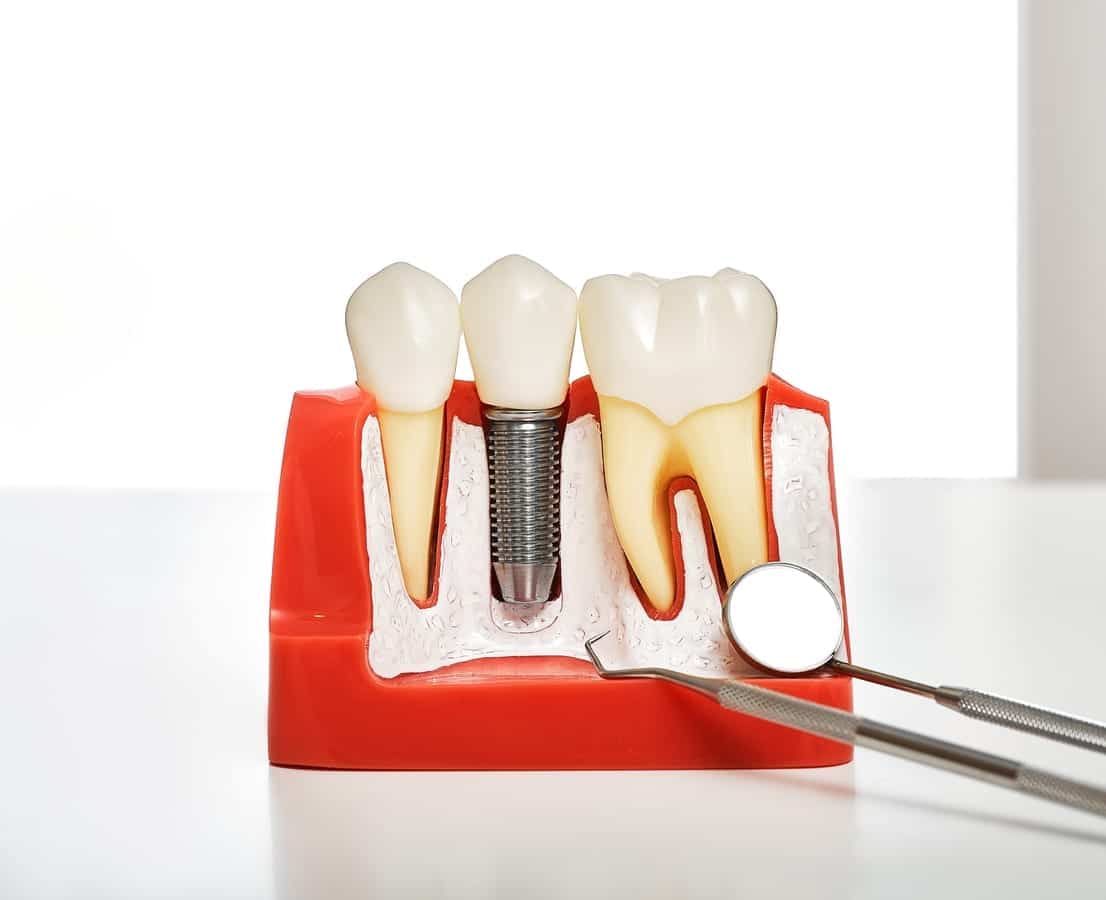 Dental Implants in